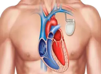 βηματοδοτης